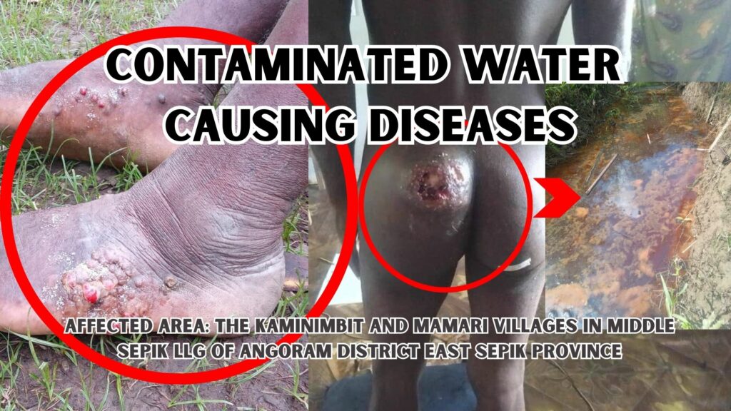 CONTAMINATED WATER CAUSING DISEASE IN THE SEPIK REGION OF PAPUA NEW GUINEA. CONTAMINATED WATER CAUSING DISEASE IN THE SEPIK REGION OF PAPUA NEW GUINEA: The East Sepik Provincial Government and the Provincial Health Authority to urgently investigate and assist the affected villagers.
